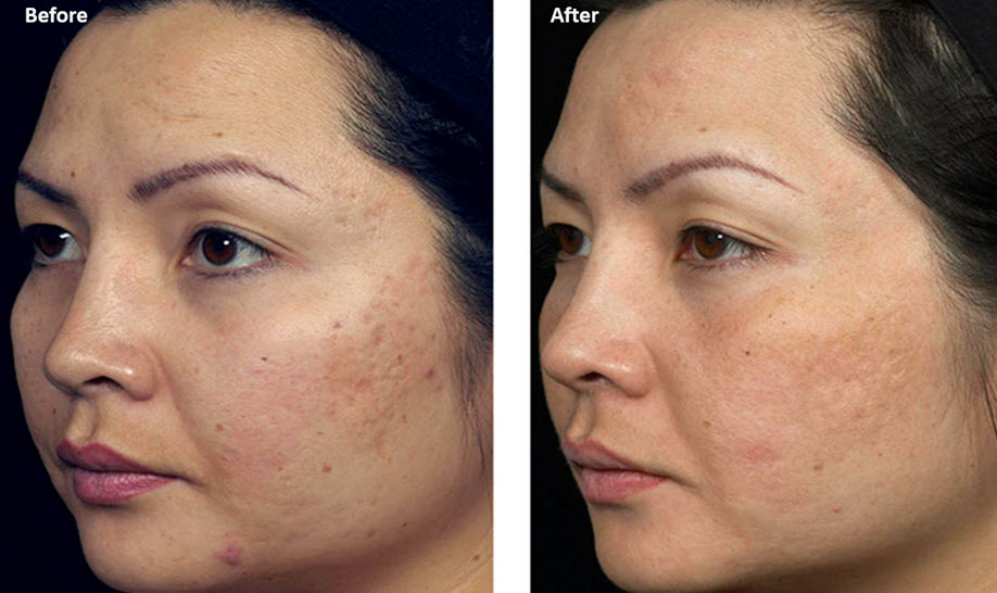 Acne scarring and MSM