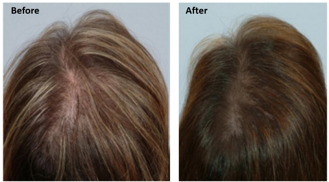 MSM For Hair Growth - Natural and Effective.